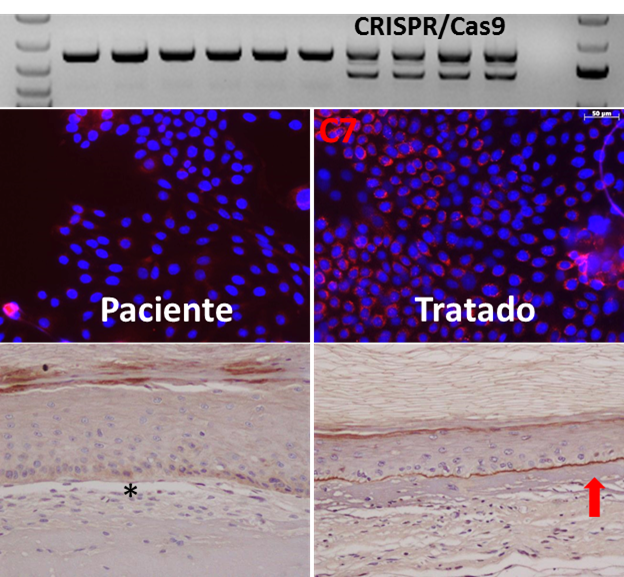 Mejoran la eficacia y precisión de la edición genómica para el tratamiento de la epidermolisis bullosa