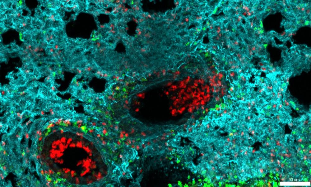 Neutrófilos (en rojo) se acumulan en los alvéolos de un pulmón infectado con gripe. Crédito: Iván Ballesteros/CNIC